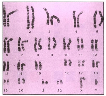 Le 23 coppie di cromosomi